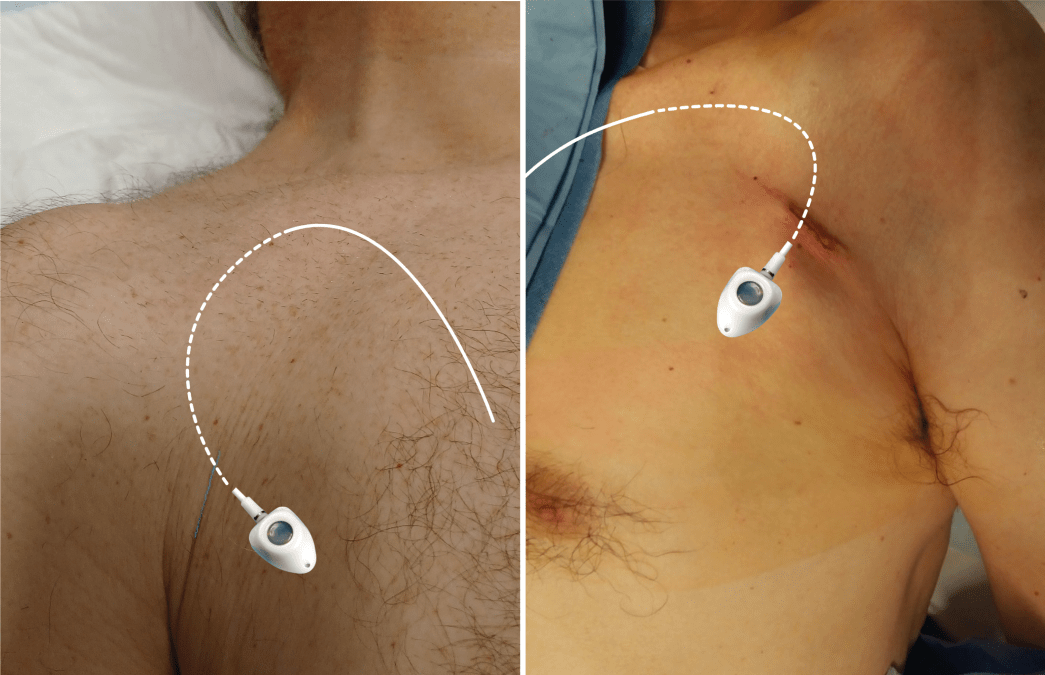 Combining aesthetics and feasibility in chest port placement