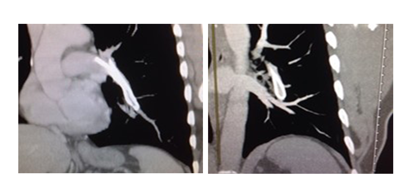 Catheter embolization in pulmonary artery, consequences of stage 3 of pinch-off syndrome