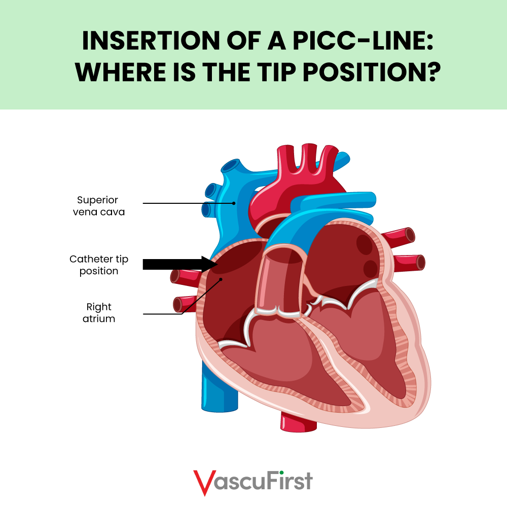 Insertion of a PICC-line: where is the tip position?