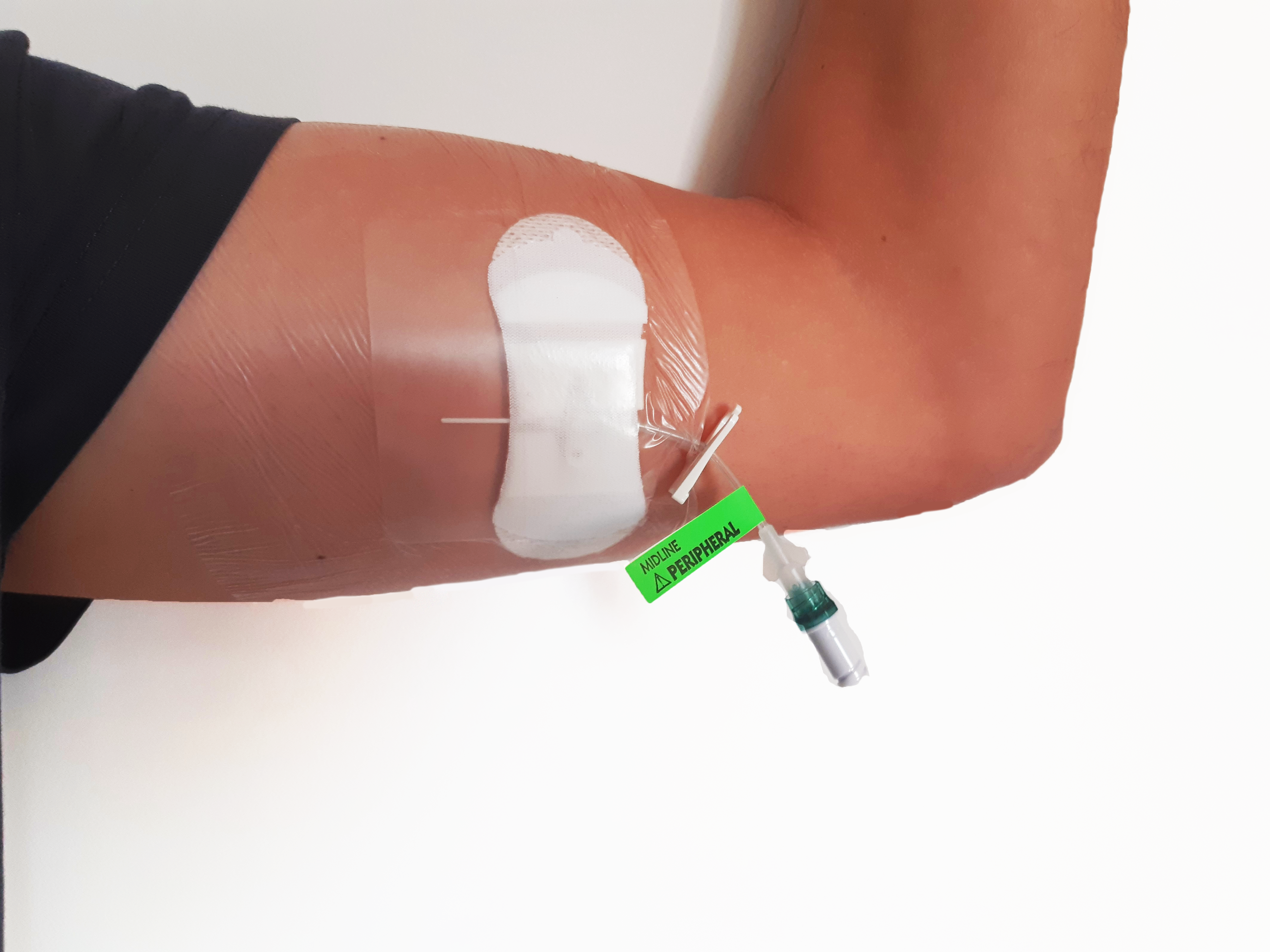 How to use the midline catheter: placement and maintenance protocol