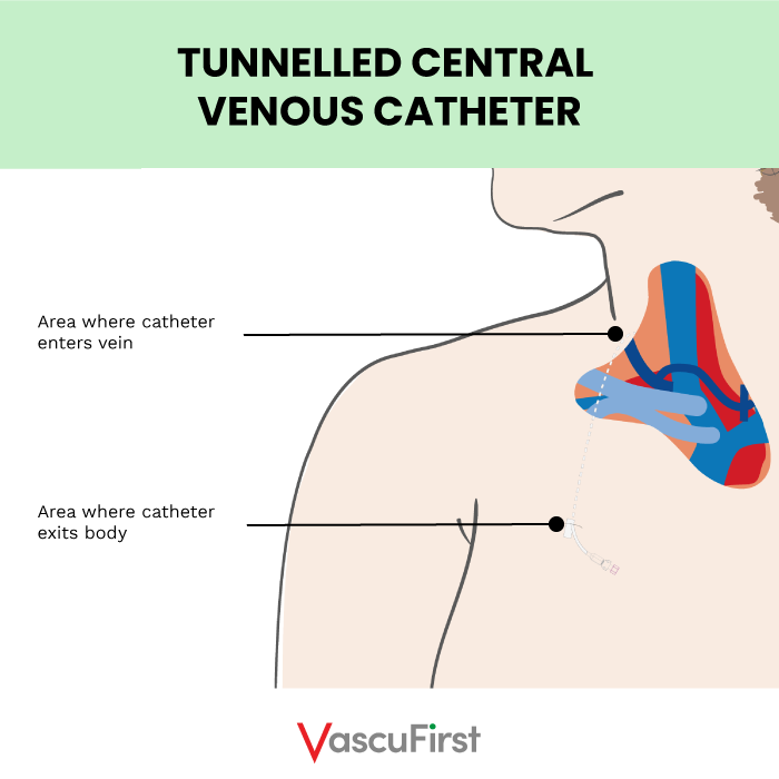 The placement of a Tunnelled Central Venous Catheter (TCVC)