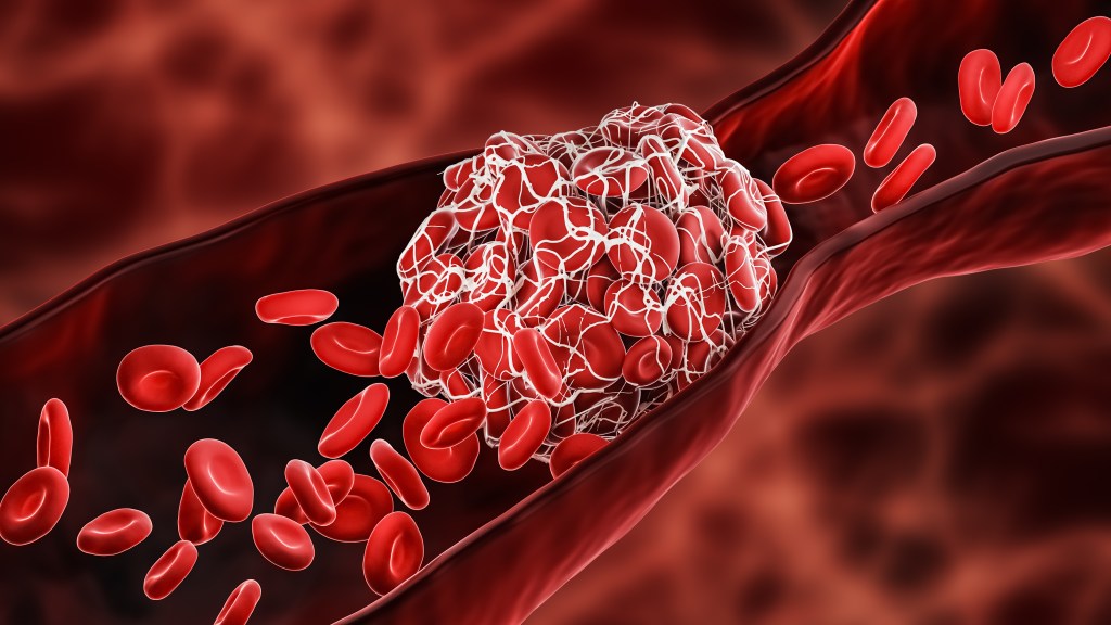 5-things-to-know-about-thrombosis-in-PICCs