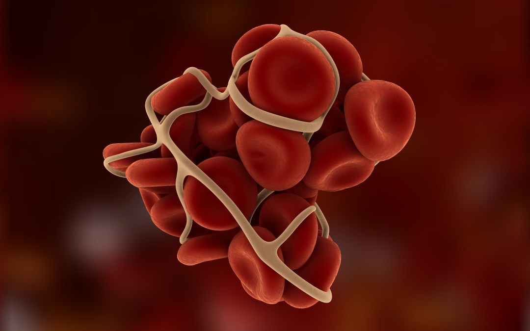 5 things to know about thrombosis in PICCs