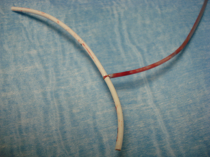 Retrieval of the fractured catheter with an endovascular lasso via the femoral route