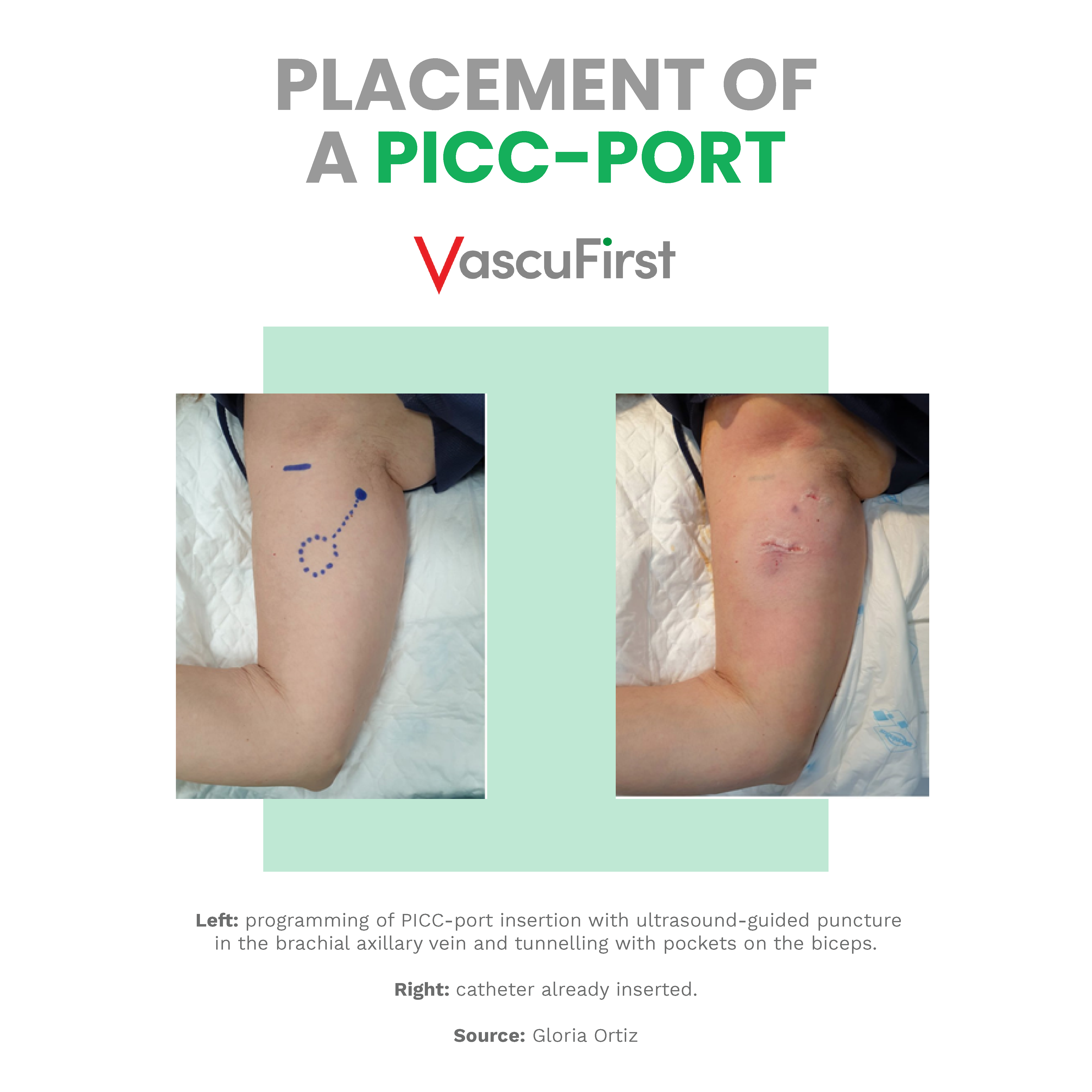 6 measures to ensure the proper functioning of a PICC-port - VascuFirst