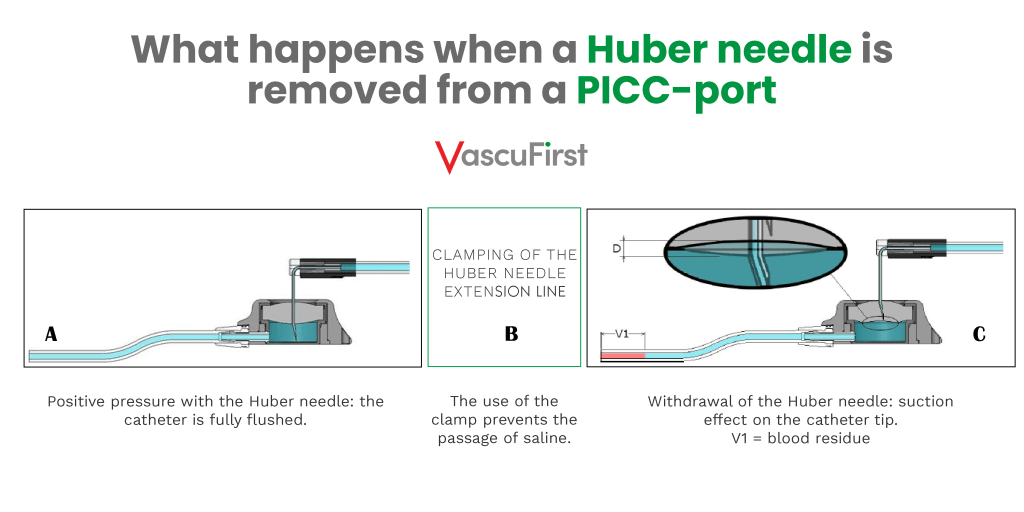 What happens when a Huber needle is removed from a PICC-port