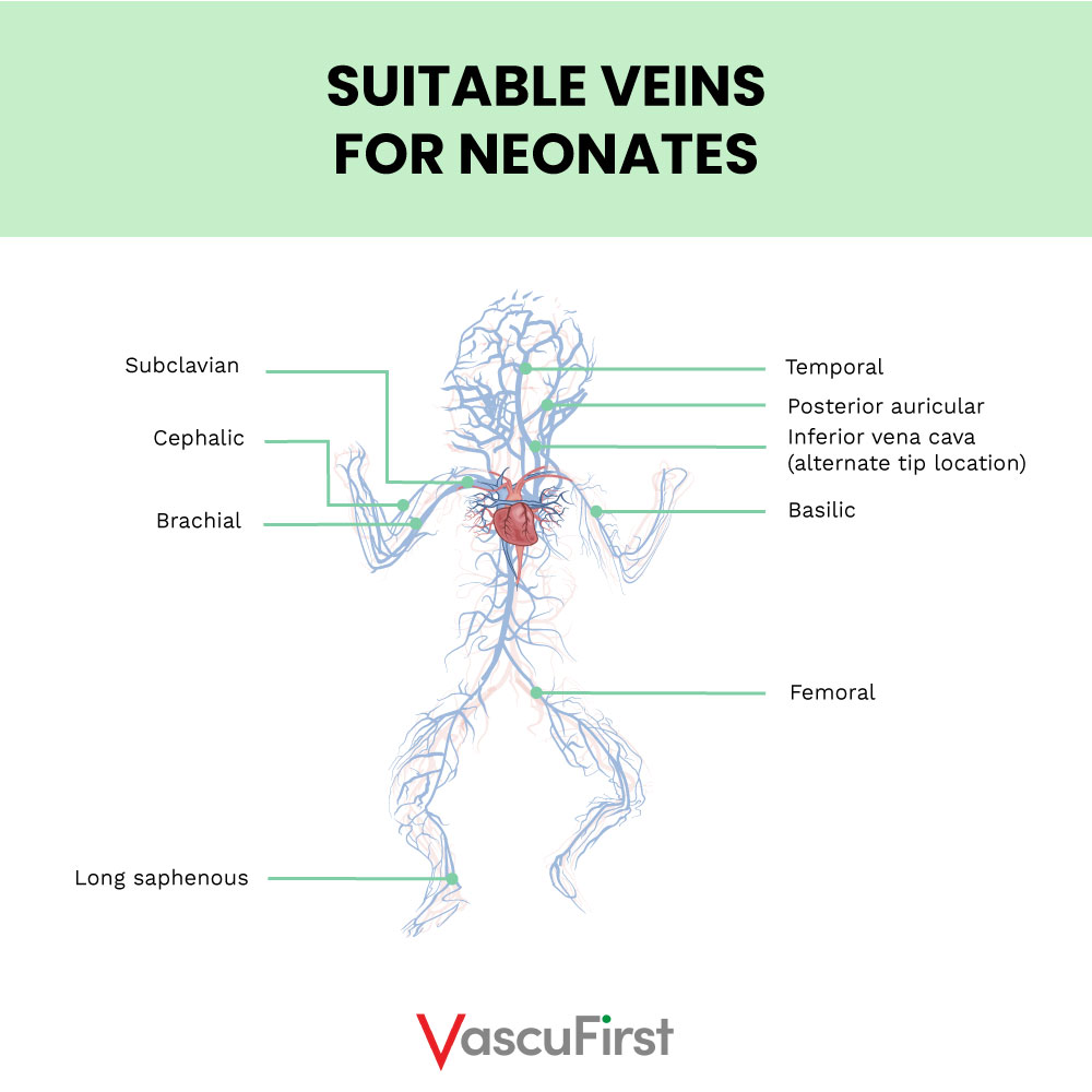 Suitable veins for neonates - Arm, chest and neck veins