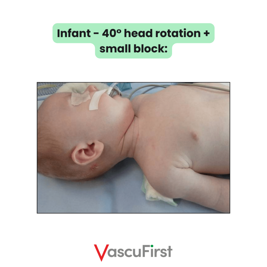 Infant - 40° head rotation + small block